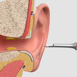 Auralis – Smart Ear Cleaning Device with Advanced Technology